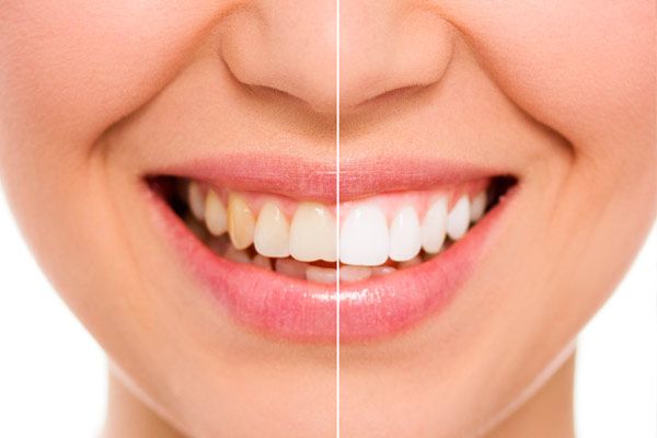 blanqueamiento dental antes y después