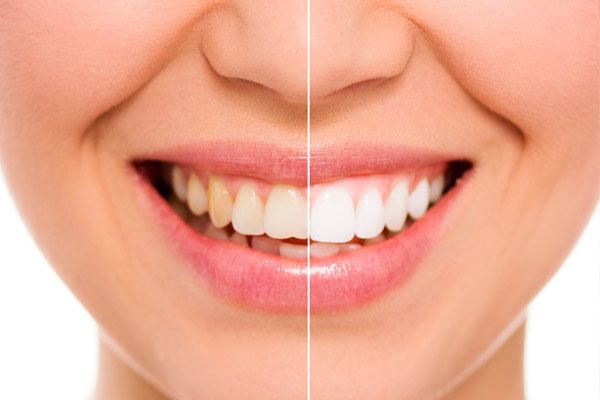blanqueamiento dental antes y después